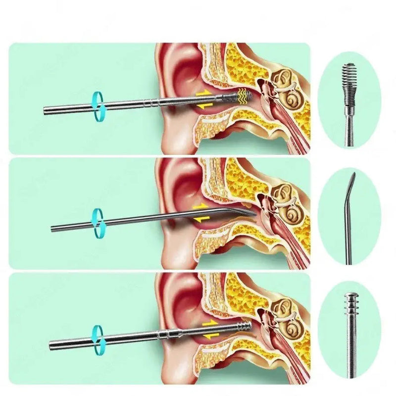 Removedor Cera De Ouvido Kit 6 Peças Aço Inox Limpeza - Ear Cleaner™